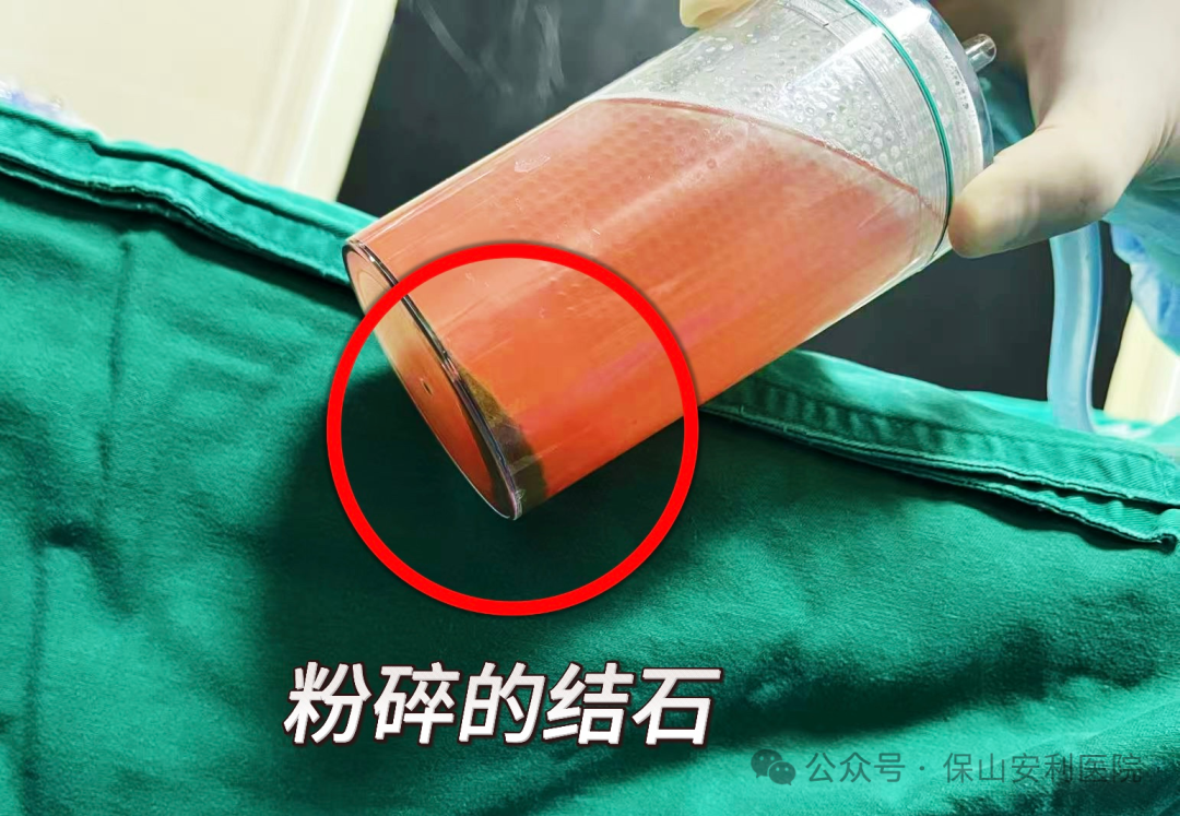 科普丨泌尿結石“克星”鈥激光碎石術，手術動圖揭秘全過程！